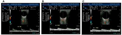 Multimodal Retinal Imaging for Detection of Ischemic Stroke